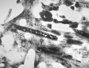 M,67y. | pseudogout - pyrophoshate arthropathy M,67y. | pseudogout - pyrophoshate arthropathy